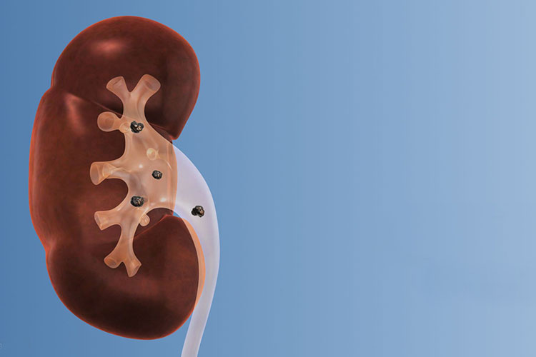 بیمار پس از اینکه سنگ کلیه از محل خود جدا شد و در مسیر دفع قرار گرفت، متوجه وجود آن خواهد شد.